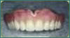 Dentadura